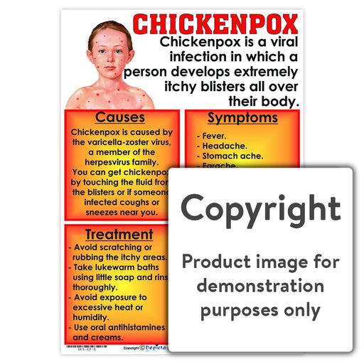 Chickenpox Wall Charts And Posters