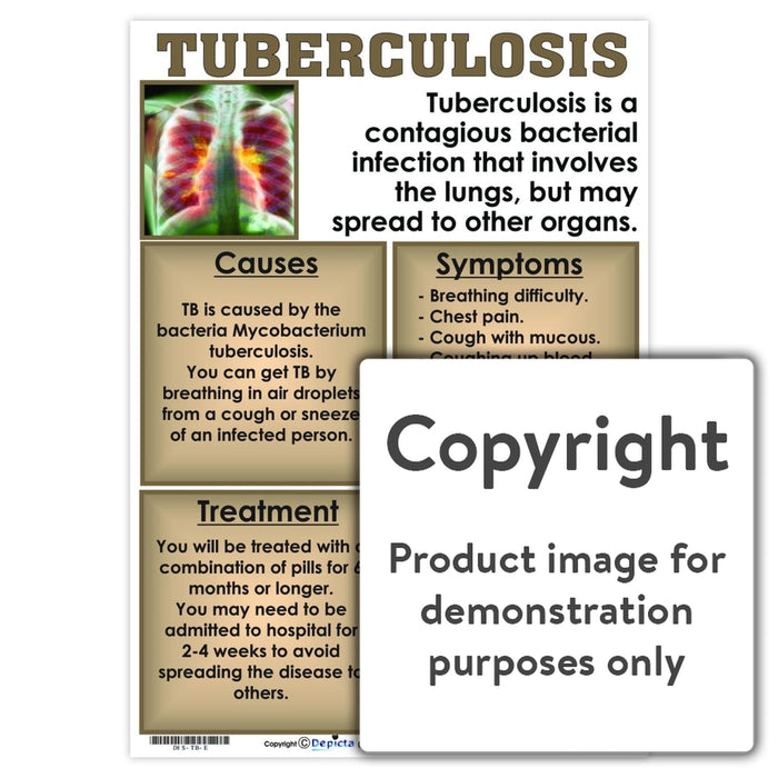Tuberculosis (Tb) Wall Charts And Posters